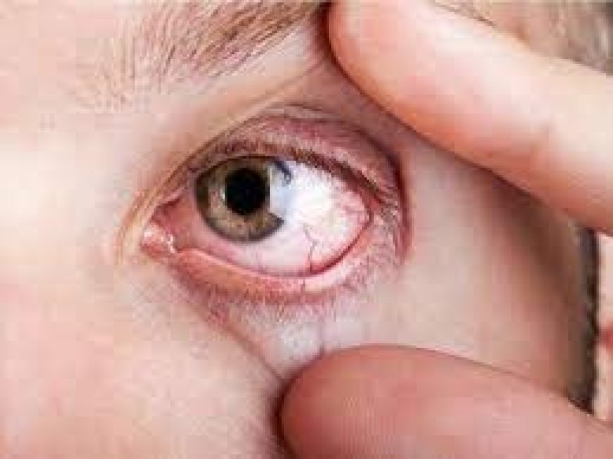 आपकी आंखों के लिए कितना खतरनाक है Eye Flu, डॉक्टर से जानें इसकी सच्चाई